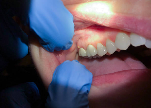 Best Emergency Denture Repair in Oriole Beach, FL